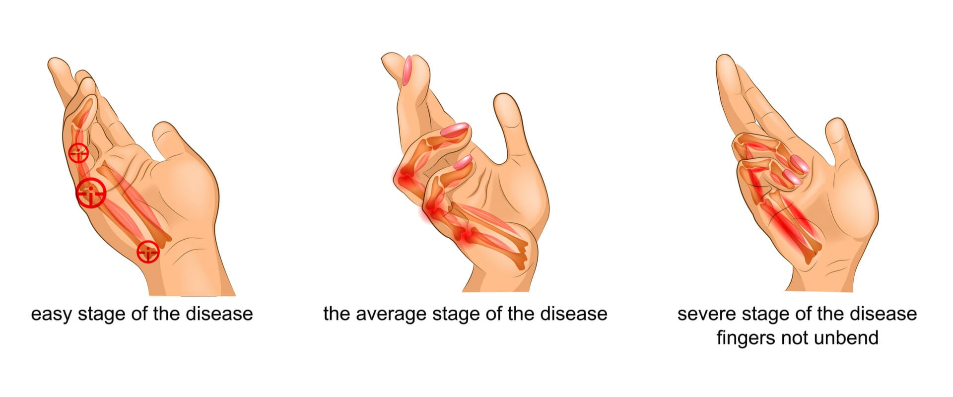 Dupuytren's contracture