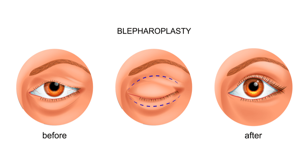 vector illustration of blepharoplasty